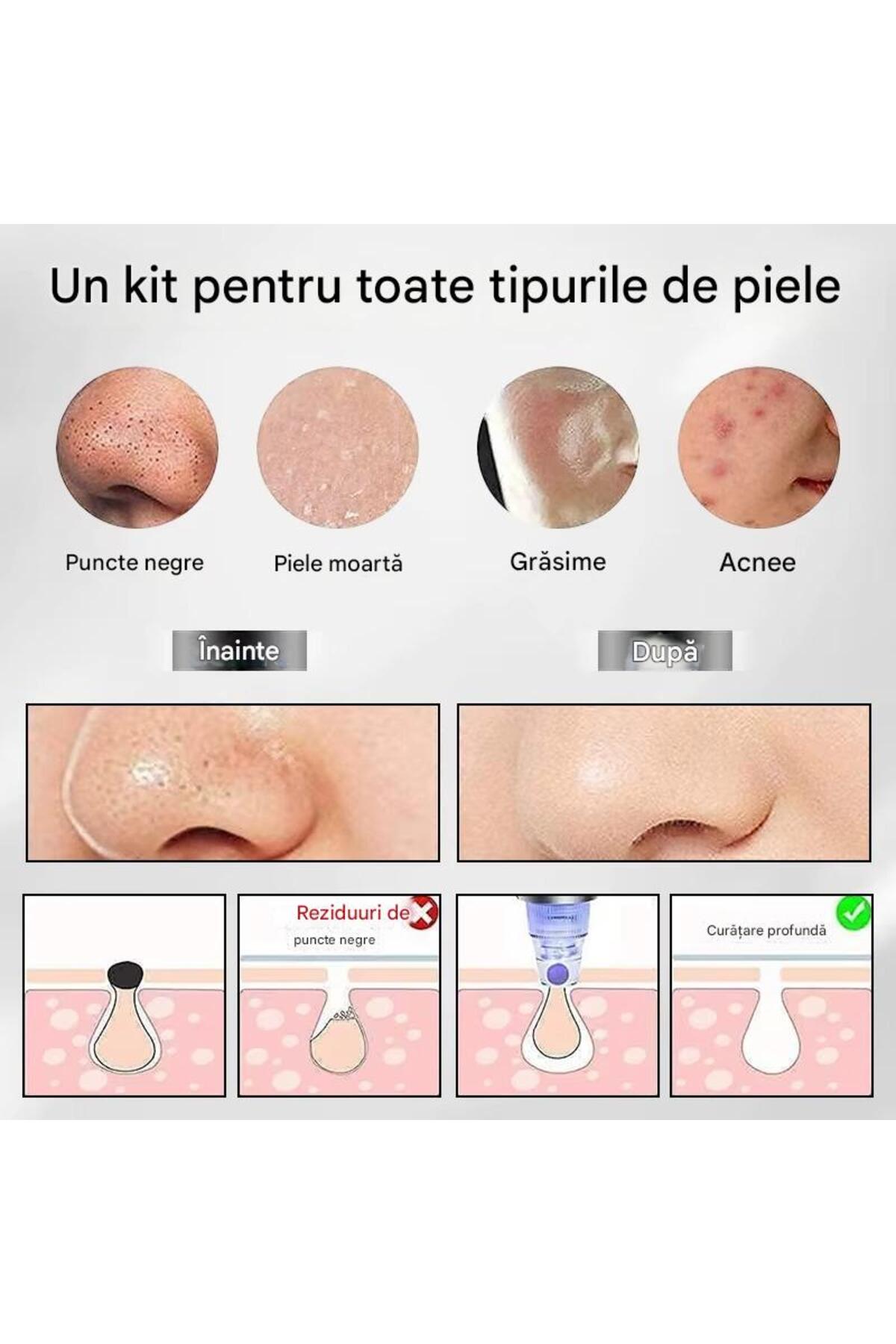 Aparat pentru curățarea tenului cu vacuum – eliminare puncte negre si pori curați